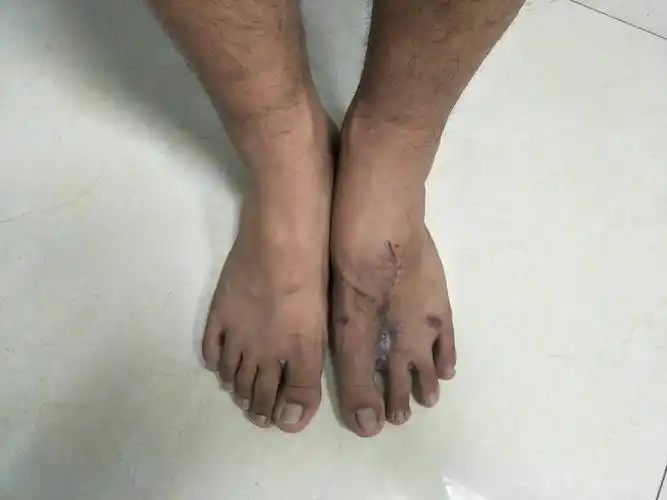 嘉宁医院骨三科足二趾移植拇指再造术