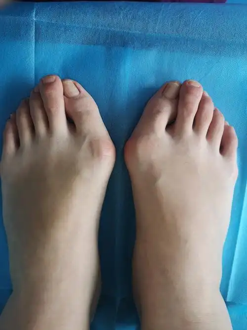 重度拇外翻