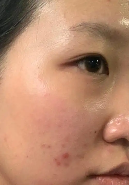 熬夜,过度清洁,皮肤屏障受损,最终一脸的闭口,一脸_圈子-新氧美容整形