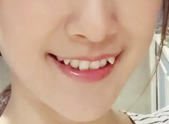 长了"虎牙"有哪些危害?怎么合理修复?