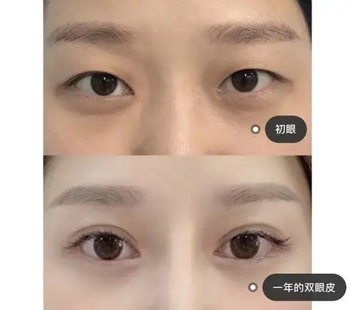 平行双眼皮图片7mm