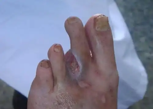 35岁男子脚趾头坏死截肢?病因竟是吸烟22年惹的祸