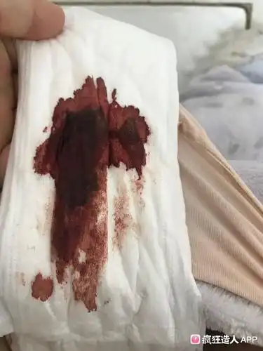 剖腹产后40几天来过姨妈,结束后五天又有血了