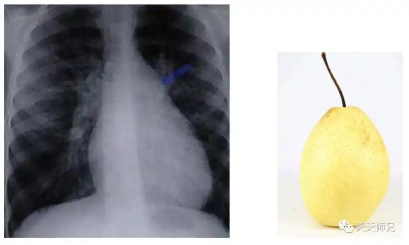 烧瓶心:患者站立位时,由于重力作用积液主要聚集在下方,从而形成烧瓶