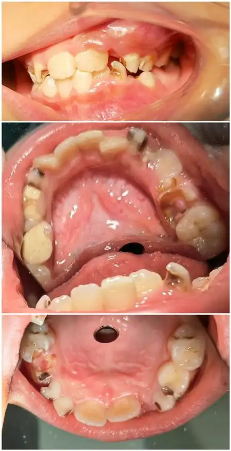 "羞于见人"的牙齿