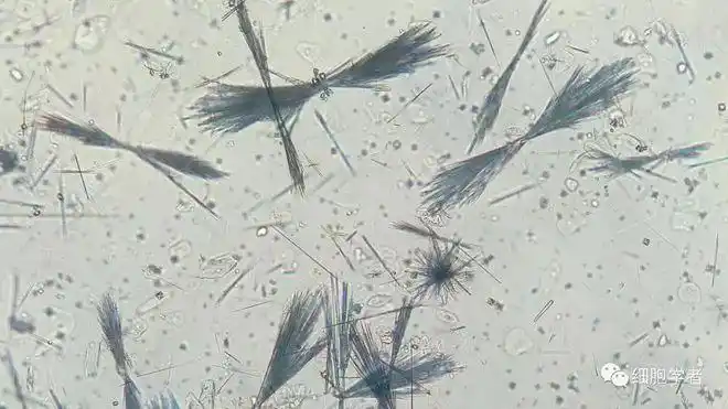 看,各种形态的尿酸结晶都在这里啦!