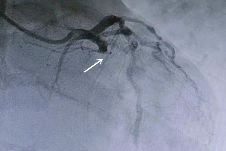 造影显示患者的冠状动脉回旋支近段完全闭塞.(翻拍照片)