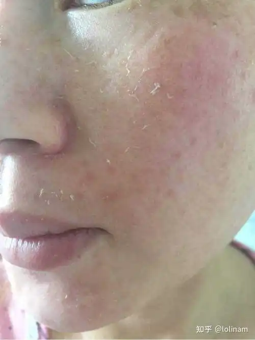 不一定非得干的爆皮,就能看到,非常缺水的皮肤其实是全是细小的裂痕