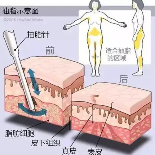 腰腹部吸脂是环吸还是分开吸?