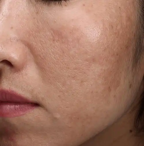 黄褐斑俗称"肝斑,妊娠斑",是一种慢性,获得性面部色素增加性皮肤病