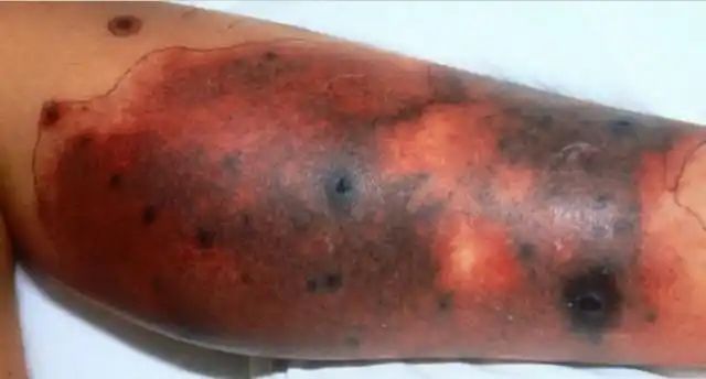 图文盘点肢端分布的血管性皮肤病