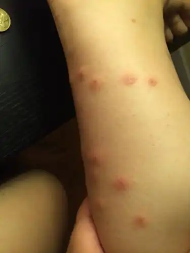 从重庆回来后,小腿上密密麻麻长了很多包,很像蚊子咬的,非常痒,擦了点