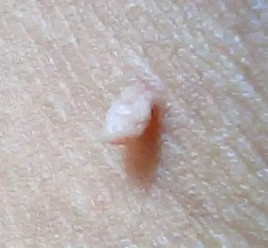 皮肤上的小肉球,小肉疙瘩是什么?不出意外,这4种可能性较大
