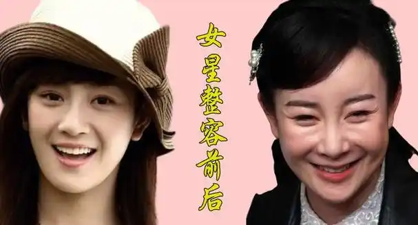 同样是面部填充,为什么王子文如此成功呢?面部填充量如何掌控