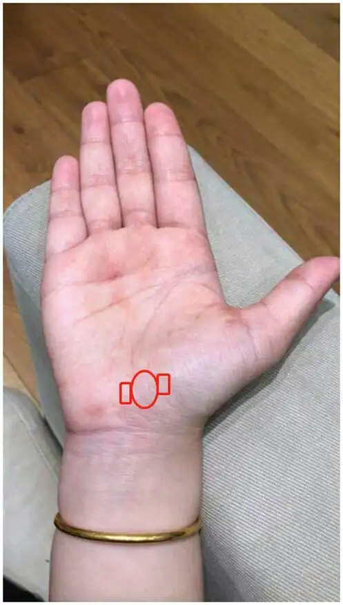 下一个卵巢囊肿 特征1:3线尾端出现2个岛纹相交,或者大岛纹里面有小岛