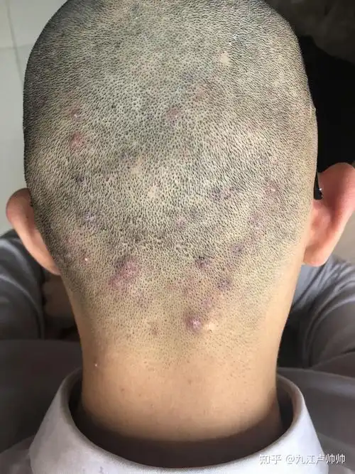 头皮毛囊炎的治疗之路