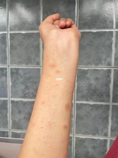 秋季 过敏性皮炎/玫瑰糠疹的进