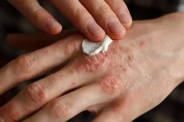 银癣怎么办(银屑病的初期症状) - 星云探秘网