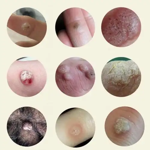 克优膏去除扁平尤脖子腋下肉粒皮赘尖锐湿尤私处疣阴道肛周疣特效 1