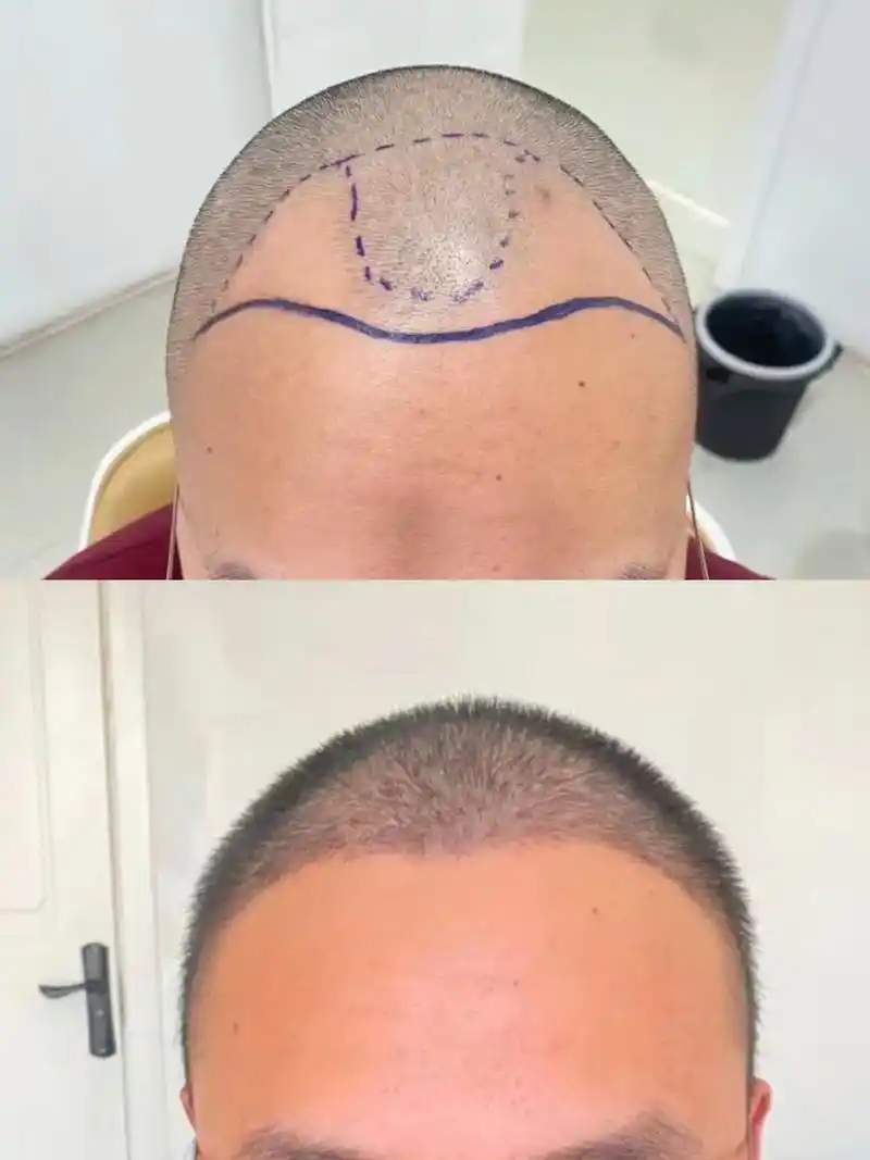 发际线种植前后效果图看出差别了嘛