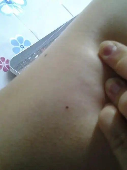 腿上突然长了两颗痣!之前没有!是不是病变?原因?