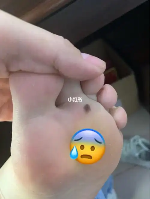 脚底痣黑色素瘤