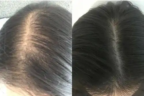 头发怎么生发 头发稀少用什么生发好在线收听_健康_喜马拉雅fm