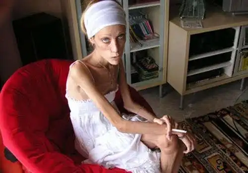 世界最瘦模特不幸身亡 令人深思