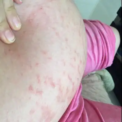 肚子的妊娠纹上长了许多红色小疙瘩,特别痒!怎麼办?