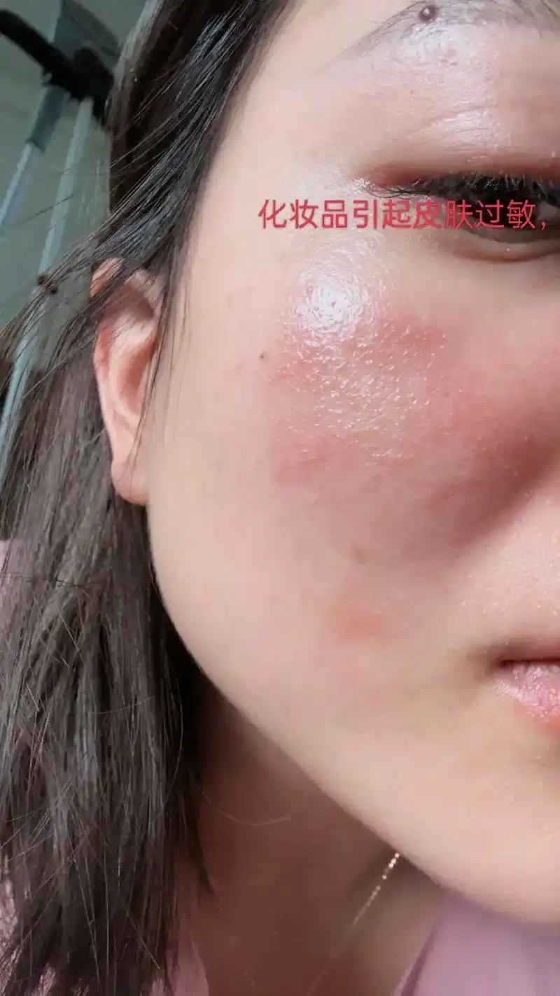 化妆品引起过敏,出水泡奇痒难忍,可是找了好多医院皮肤科医生所谓的