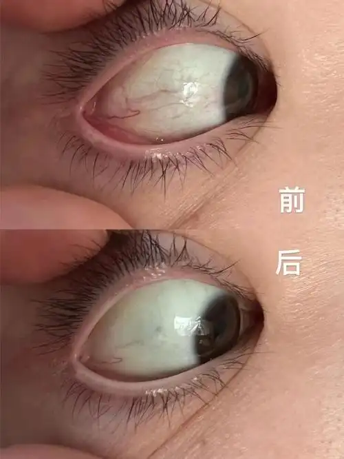 红血丝眼干眼疲劳的克星