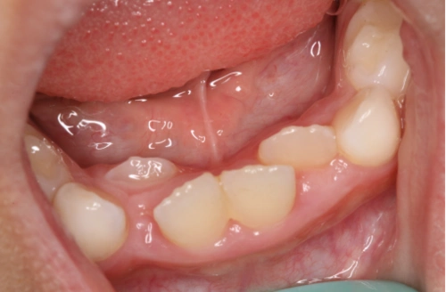 儿童下门牙双排牙是怎么回事