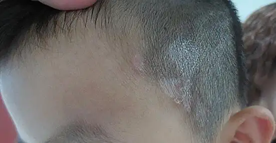 580孩子头上白斑症状.jpg