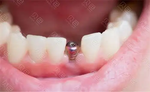 上海瑞伢美口腔种植牙示意图