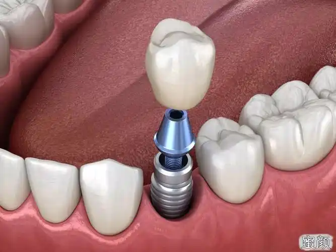 3d数字化种植牙——带您重启舌尖上的幸福