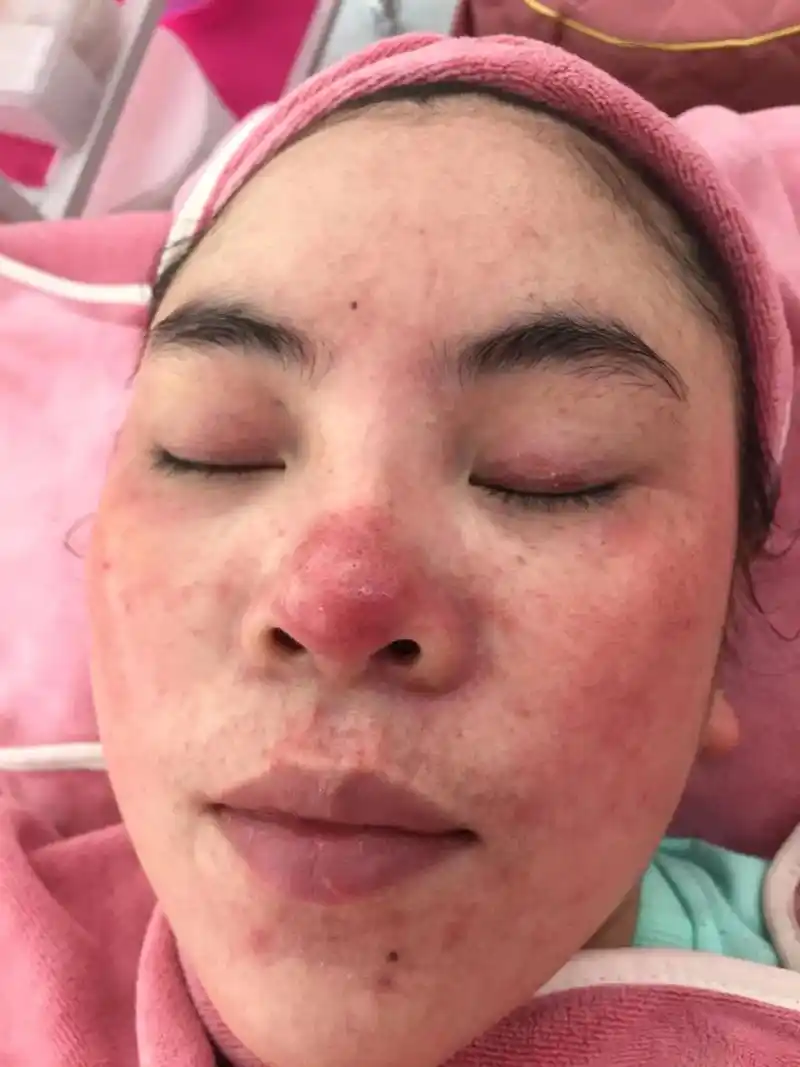 这个小姐姐满脸痘痘然后在医院刷过果酸   也用了别的产品   - 抖音