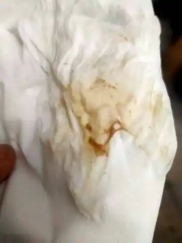 怀孕40天,今天中午出现褐色分泌物,朋友们.没事吧,跪求,谢谢