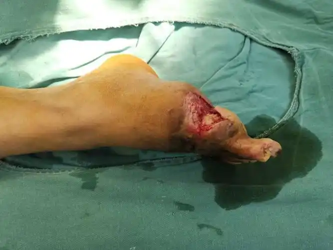 断足再植术后部分坏死,足底内皮瓣修复