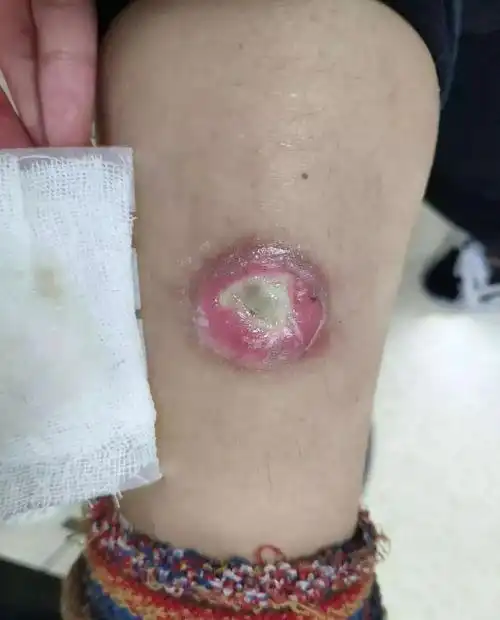 烫伤后有没有不用换药的治疗方案?