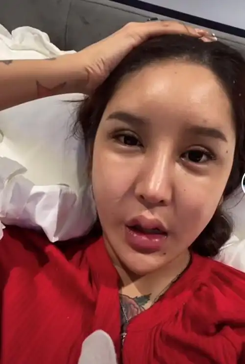 网红整容又失败花费百万额头却现巨坑曾面部神经遭压迫险失明