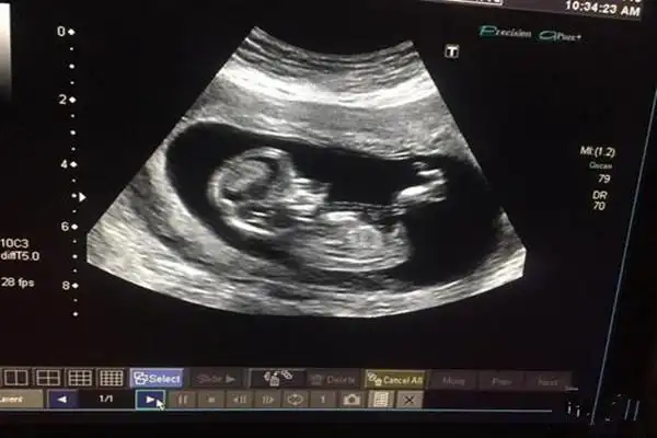 是不是所有的nt图像,有三条线的都表示生女孩呢?