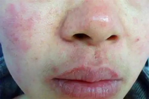 孕妇皮炎专科医院_儿童医药,保养-芜湖中科皮肤病研究院