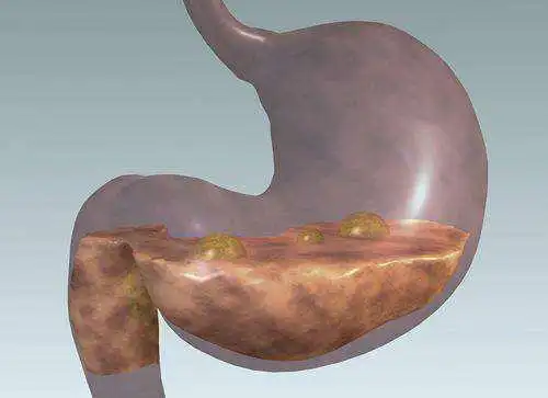 吐出来的胆汁到底是什么颜色?(重口味慎入)