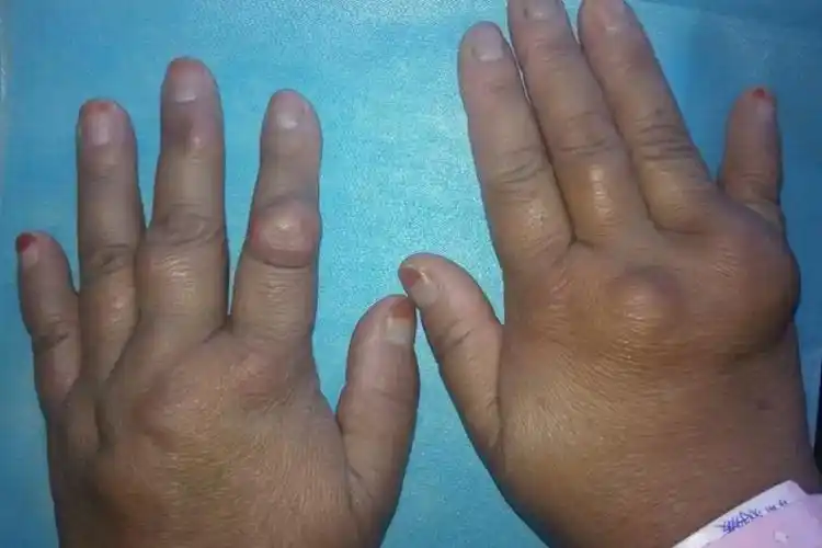 透明细胞肉瘤早期图片