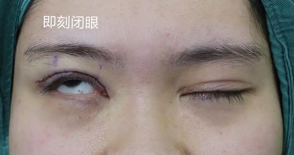 上睑下垂术后12天图片(河北90后姑娘右眼上睑下垂做了一次效果不好) -