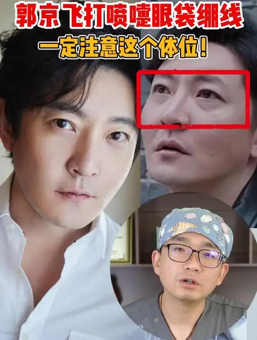 郭京飞眼袋术后打喷嚏绷线!这几个问题千万注意!