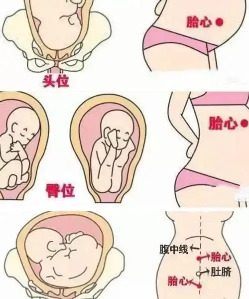 胎心在孕妇肚脐上下方多数是胎位不正胎位正胎心在这个位置