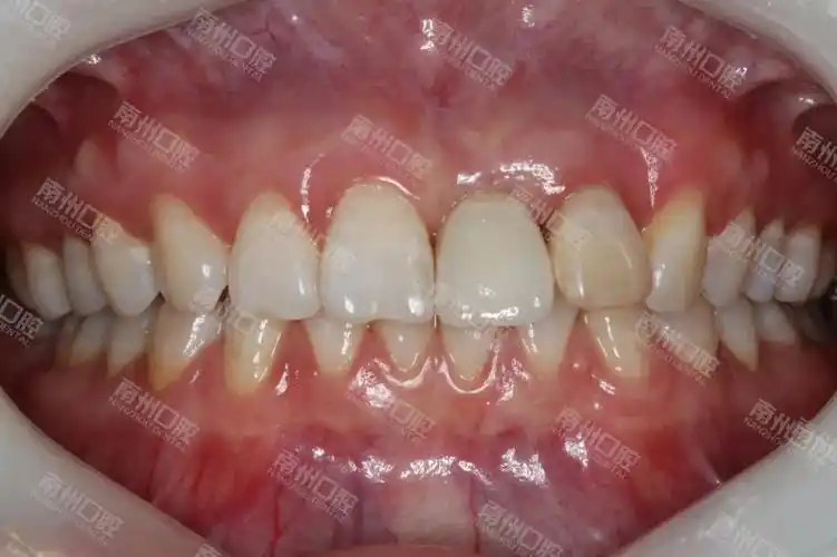 门牙折断,种植牙修复案例分享