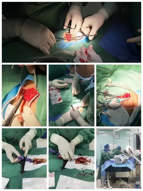 开窗覆膜支架治疗急性stanford b型主动脉夹层1例