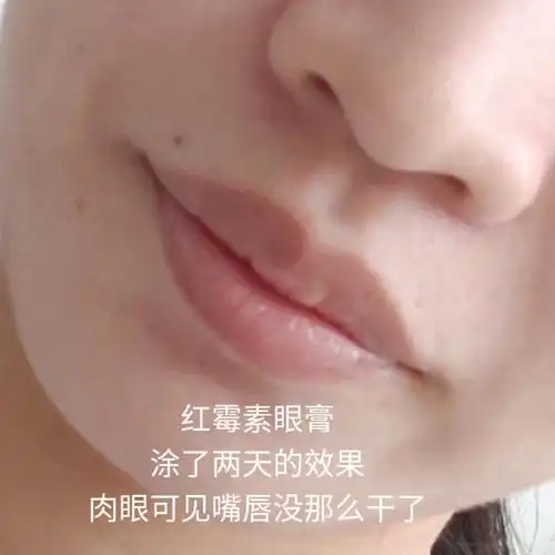 红霉素眼膏涂嘴唇